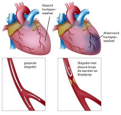 Alles Over Pre Infarct Oorzaken Symptomen En Behandeling Diagnoses