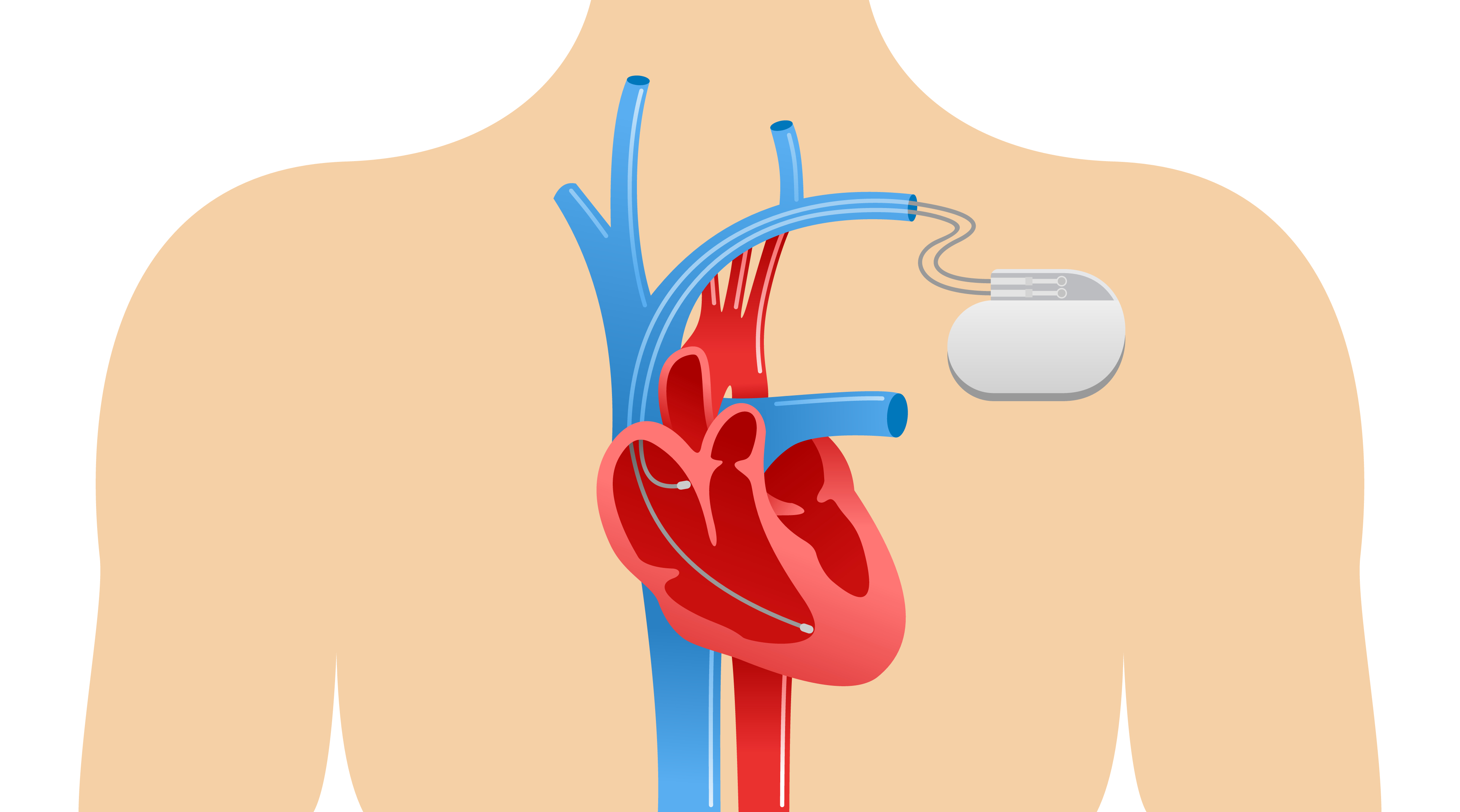 Pacemaker, inbrengen van een (pacemakerimplantatie) - Alrijne Ziekenhuis