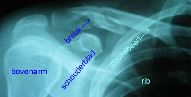 Claviculafractuur (sleutelbeenbreuk) - Alrijne Ziekenhuis