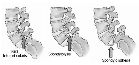 Weergaven van de rugwervels bij Pars Interacticularis, Spondylolysis of Spondylolisthesis