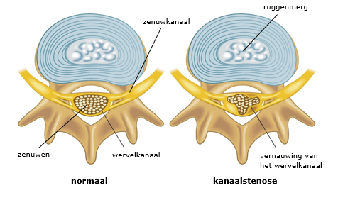 kanaalstenose