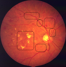 diabetische retinopathie