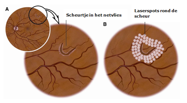 Laserbehandeling van het netvlies - Alrijne Ziekenhuis