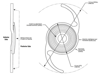 schematische weergave van een torische multifocale lens