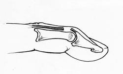 illustratie van malletvinger (inwendig)