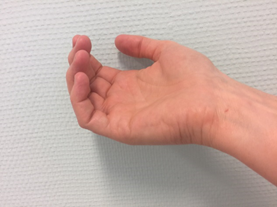 vingeroefening bij afbouwen van malletspalk